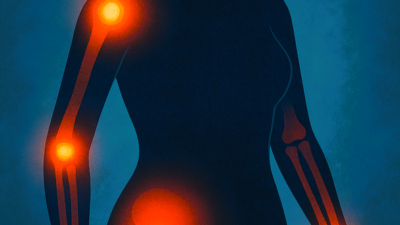 Rheuma haben vor allem Frauen !